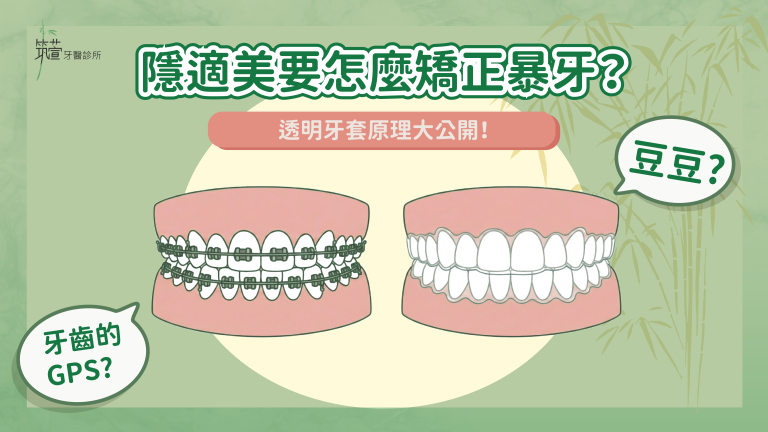 隱適美要怎麼矯正暴牙？透明牙套原理大公開！